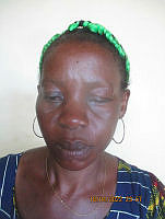 Oyem : une femme perd un œil dans une dispute conjugale