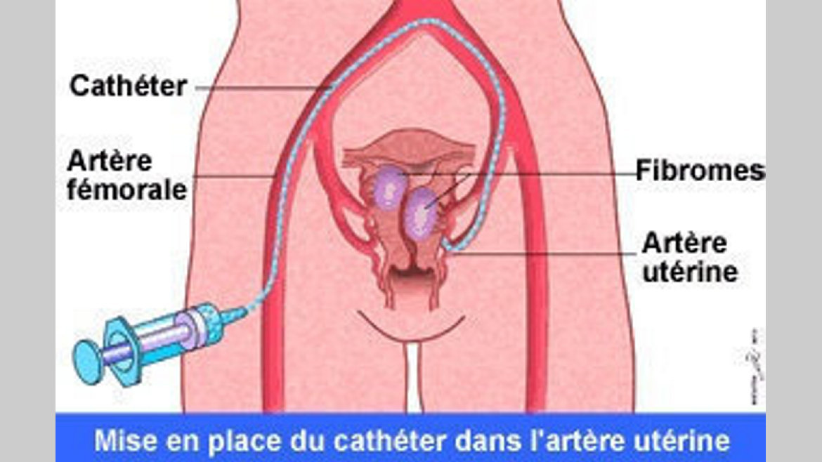Fibrome utérin : L'embolisation, une solution définitive