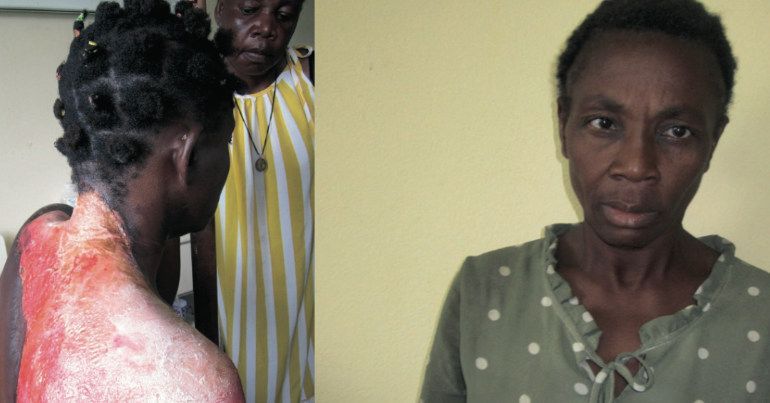L’état de Raïssa Nfono Ndong après avoir été ébouillantée par sa belle-sœur Sophie Oyane L’état de Raïssa Nfono Ndong après avoir été ébouillantée par sa belle-sœur Sophie Oyane
