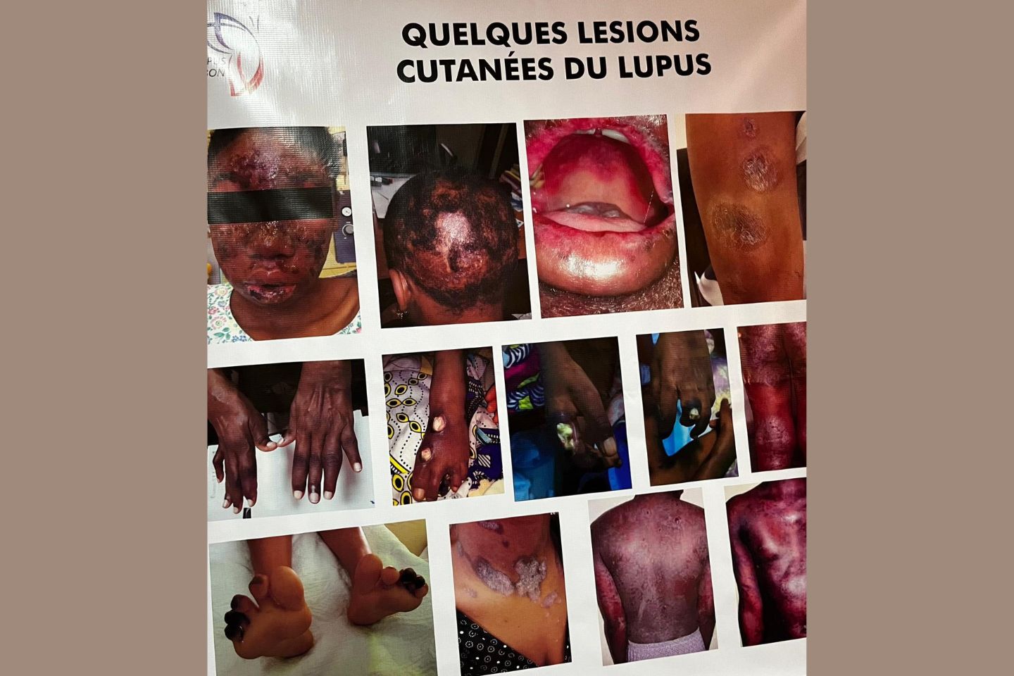 Conséquences esthétiques du lupus : un impact profond Marques cutanées profondes: quelques cas de lupus
